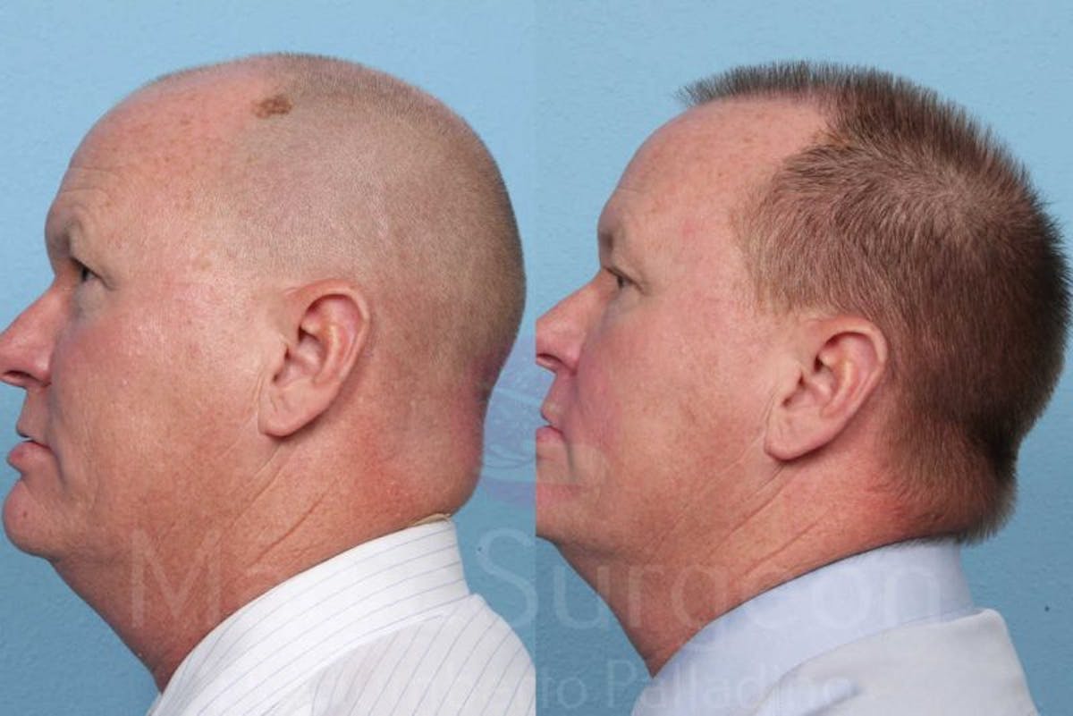 Hair Transplant Before & After Gallery - Patient 133182461 - Image 3