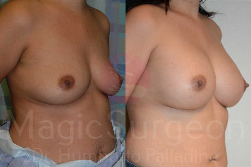 Breast Augmentation Before & After Gallery - Patient 133182463 - Image 4