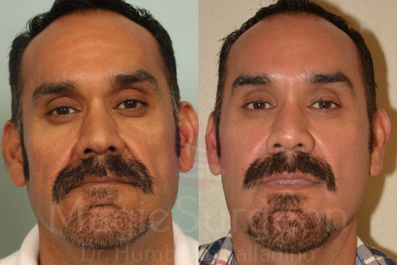Male Facial Rejuvenation Before & After Gallery - Patient 133182464 - Image 1