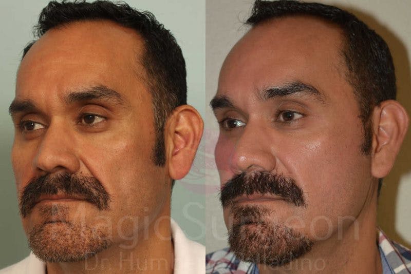 Male Facial Rejuvenation Before & After Gallery - Patient 133182464 - Image 2