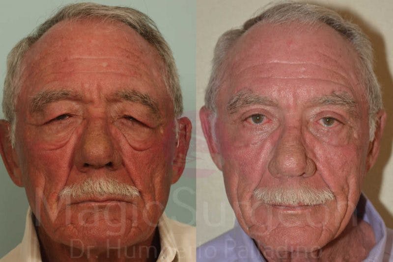 Male Facial Rejuvenation Before & After Gallery - Patient 133182466 - Image 1