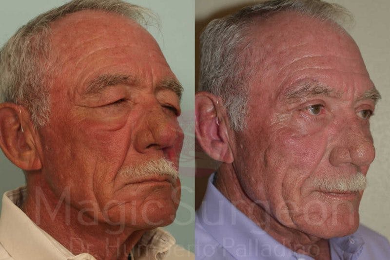 Male Facial Rejuvenation Before & After Gallery - Patient 133182466 - Image 4