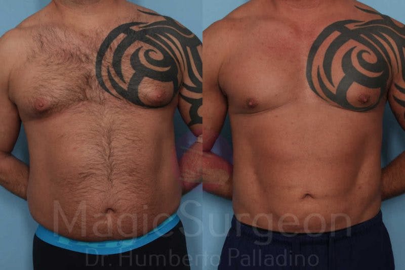 Male HD Liposculpture Before & After Gallery - Patient 133182467 - Image 1