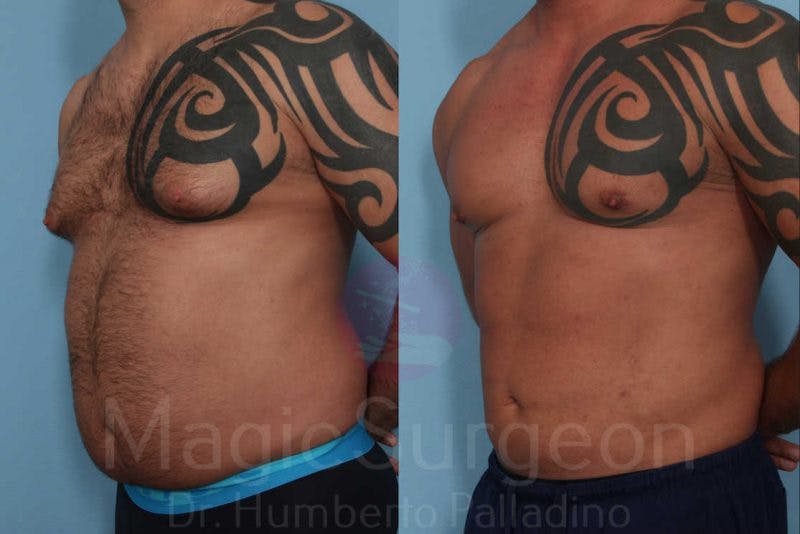 Male HD Liposculpture Before & After Gallery - Patient 133182467 - Image 2