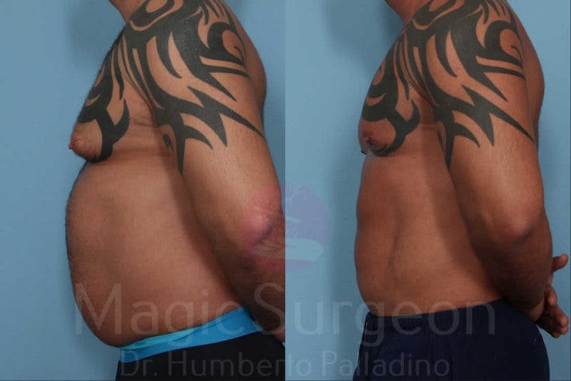 Male HD Liposculpture Before & After Gallery - Patient 133182467 - Image 3