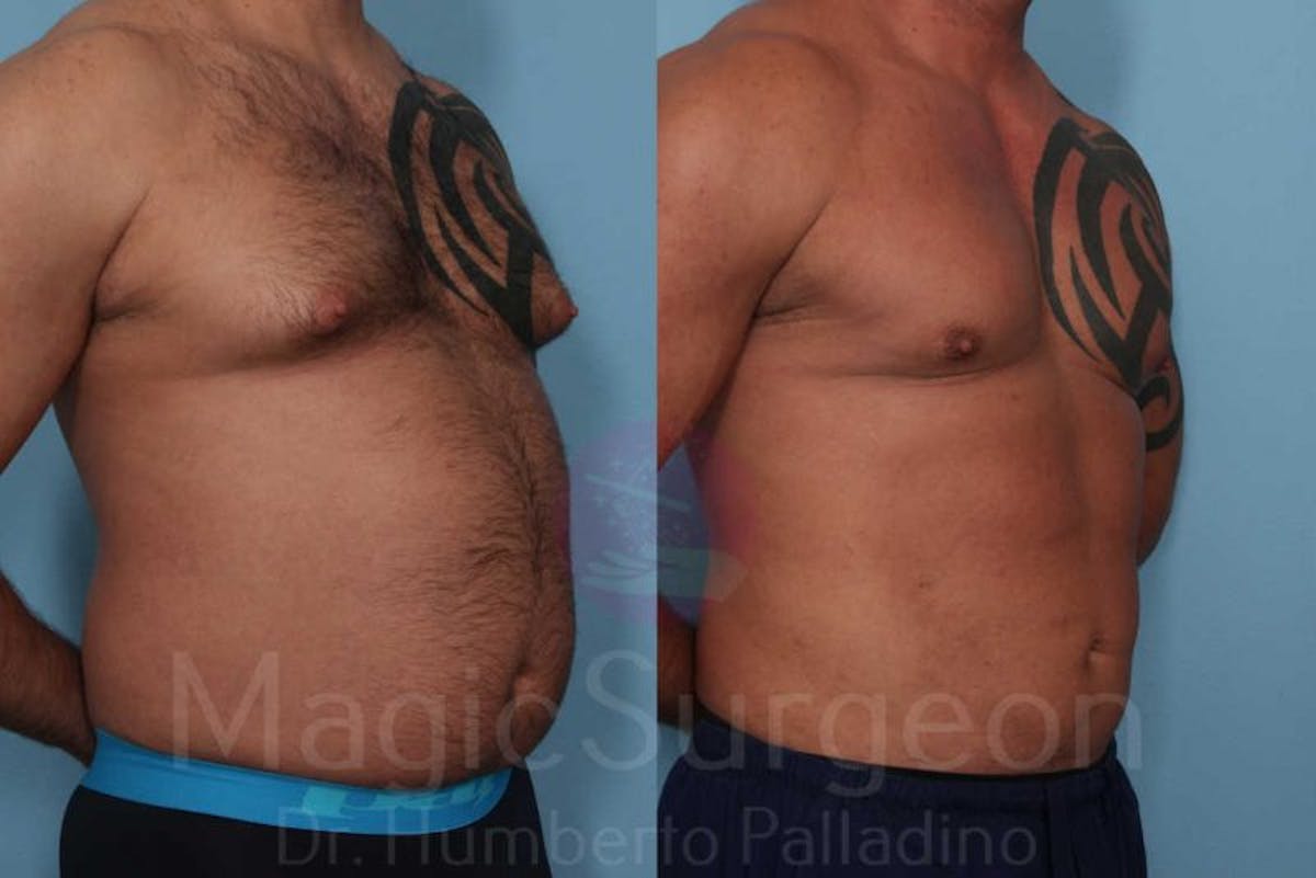 Male HD Liposculpture Before & After Gallery - Patient 133182467 - Image 4