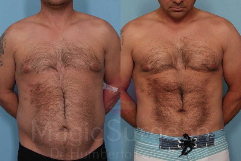 Male HD Liposculpture Before & After Gallery - Patient 133182468 - Image 1