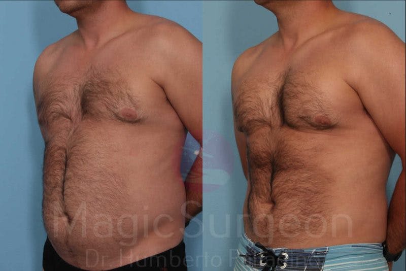 Male HD Liposculpture Before & After Gallery - Patient 133182468 - Image 2