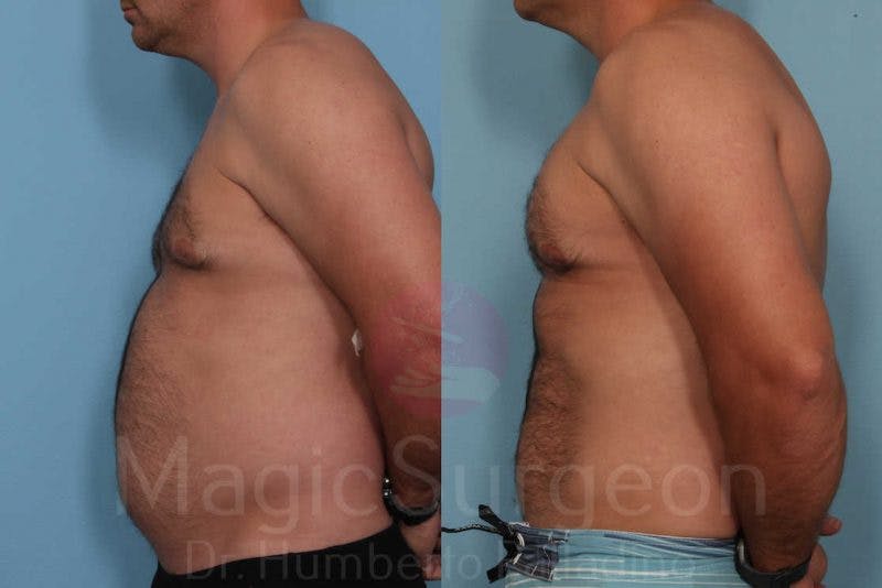 Male HD Liposculpture Before & After Gallery - Patient 133182468 - Image 3