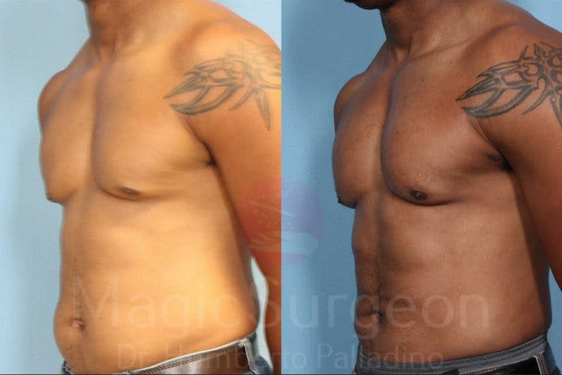 Male HD Liposculpture Before & After Gallery - Patient 133182469 - Image 2