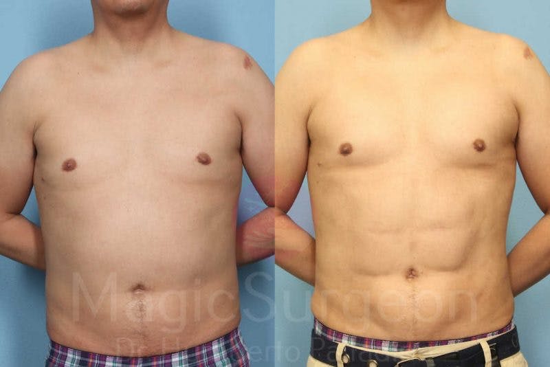 Male HD Liposculpture Before & After Gallery - Patient 133182470 - Image 1