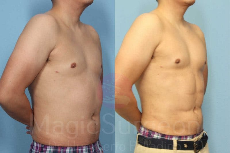 Male HD Liposculpture Before & After Gallery - Patient 133182470 - Image 4