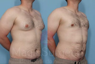 Male HD Liposculpture Before & After Gallery - Patient 133182471 - Image 1