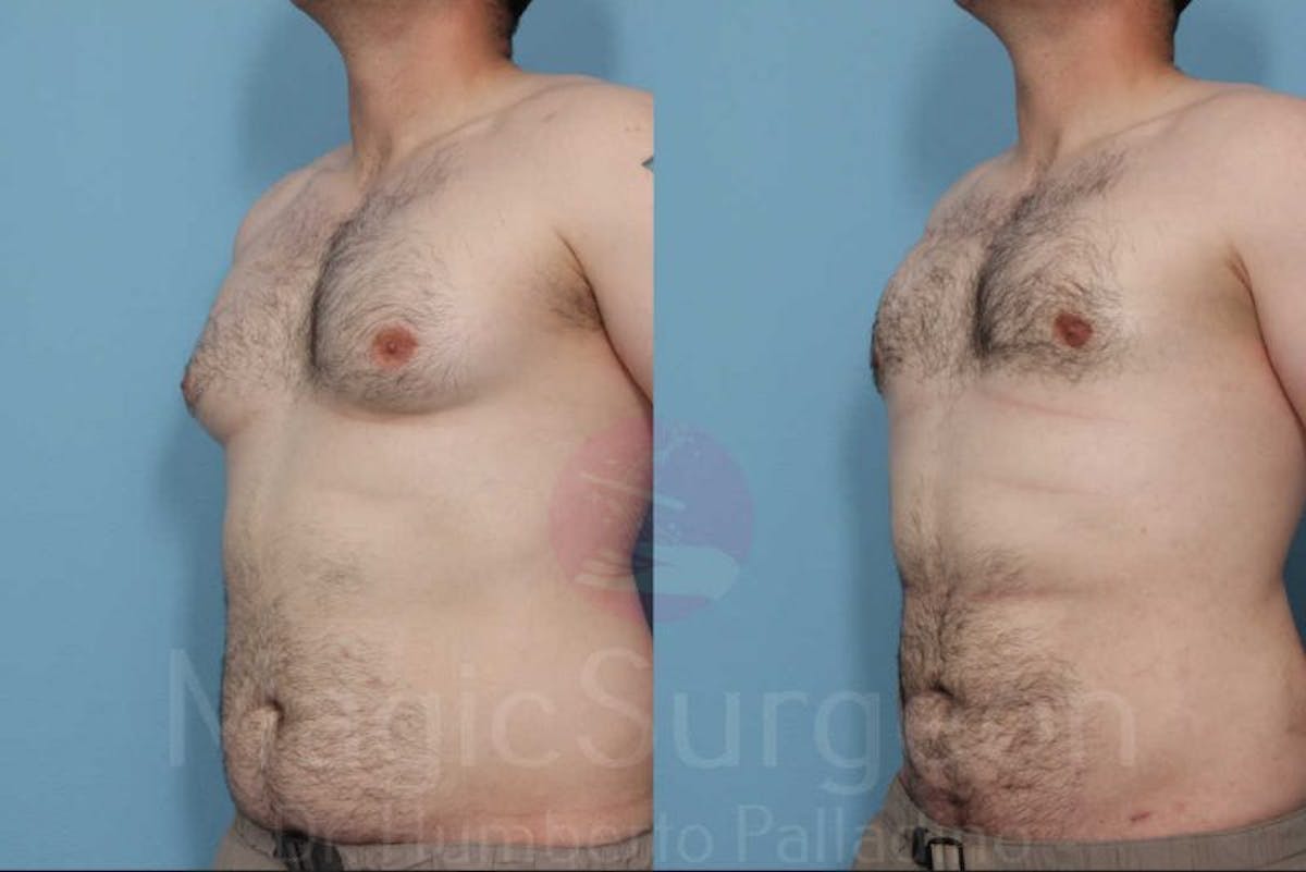 Male HD Liposculpture Before & After Gallery - Patient 133182471 - Image 3