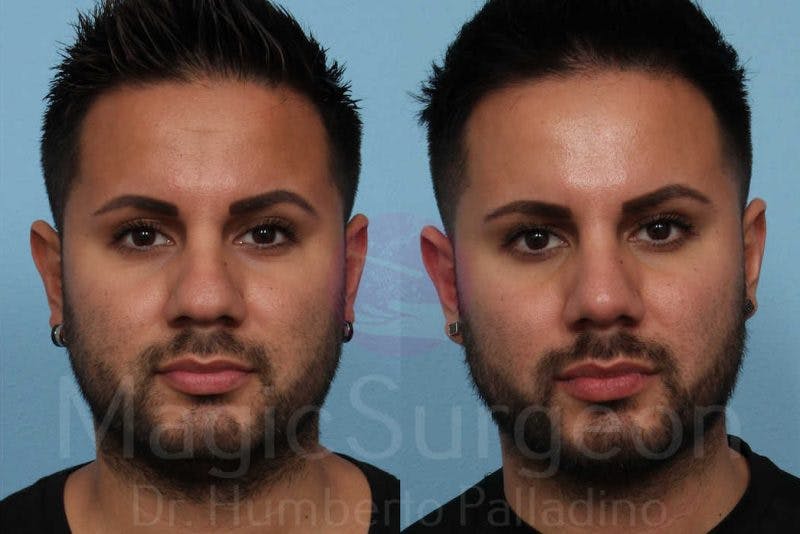 Men's Rhinoplasty Before & After Gallery - Patient 133182472 - Image 1
