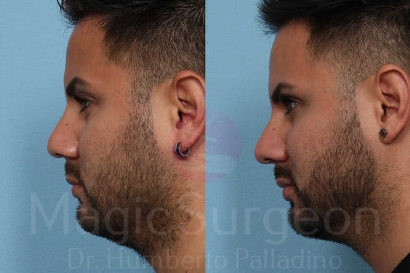 Men's Rhinoplasty Before & After Gallery - Patient 133182472 - Image 3