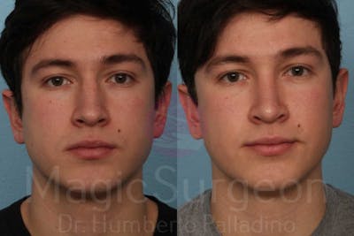 Men's Rhinoplasty Before & After Gallery - Patient 133182473 - Image 1