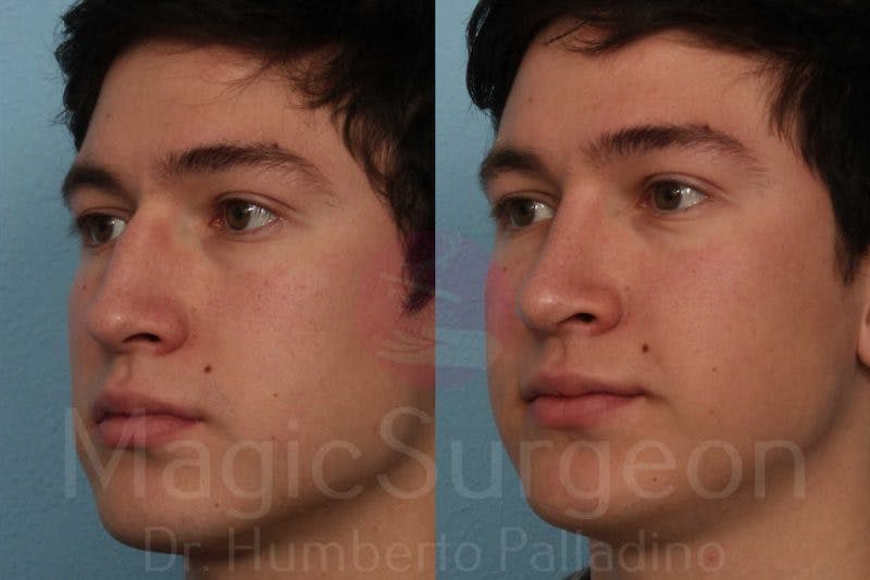 Men's Rhinoplasty Before & After Gallery - Patient 133182473 - Image 2