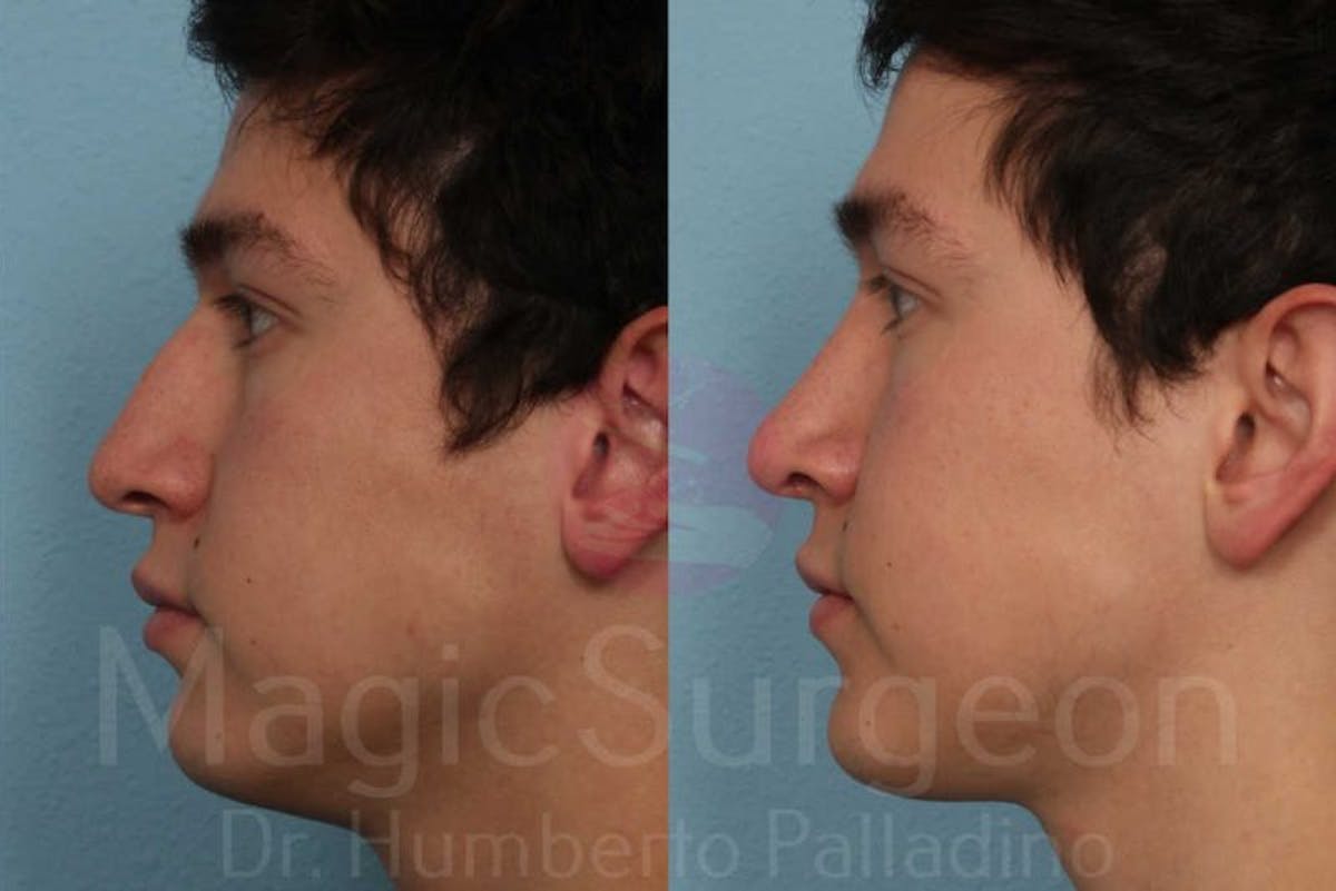 Men's Rhinoplasty Before & After Gallery - Patient 133182473 - Image 3