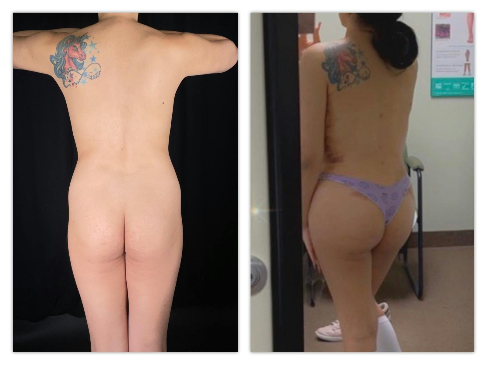 Tummy Tuck Before & After Gallery - Patient 133183612 - Image 2
