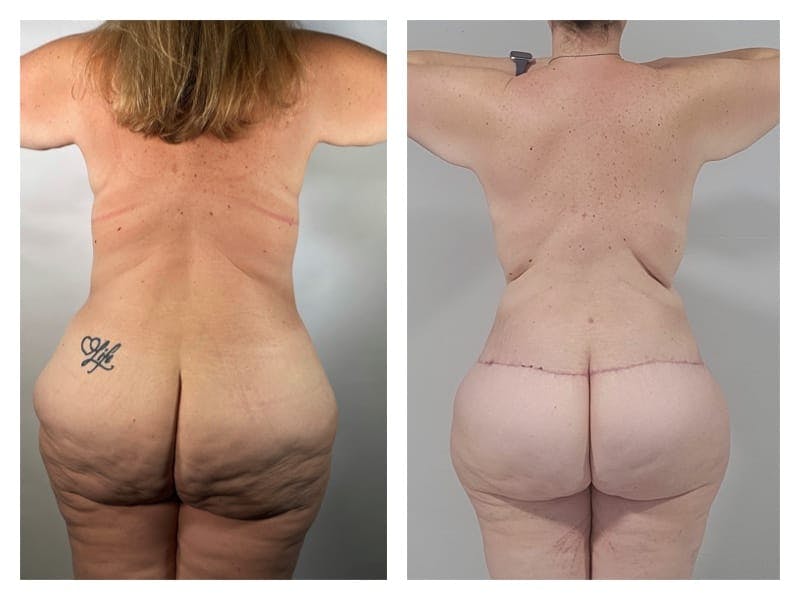 Brazilian Butt Lift Before & After Gallery - Patient 133183634 - Image 1