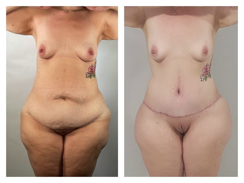 Brazilian Butt Lift Before & After Gallery - Patient 133183634 - Image 2