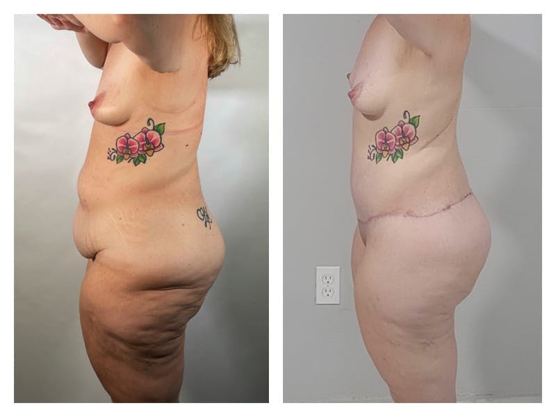Brazilian Butt Lift Before & After Gallery - Patient 133183634 - Image 3