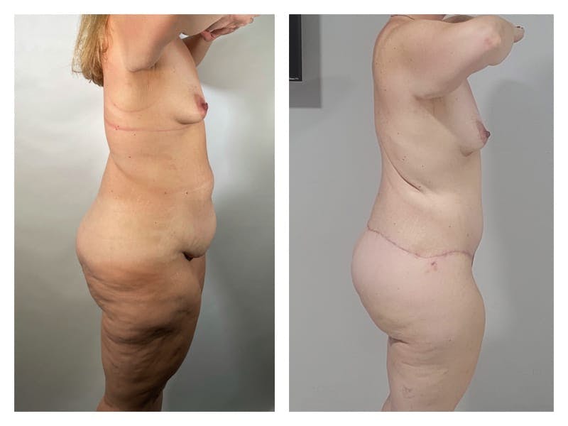 Brazilian Butt Lift Before & After Gallery - Patient 133183634 - Image 4