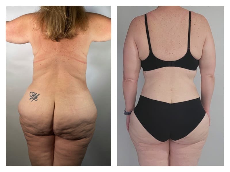 Liposuction Before & After Gallery - Patient 133183636 - Image 2