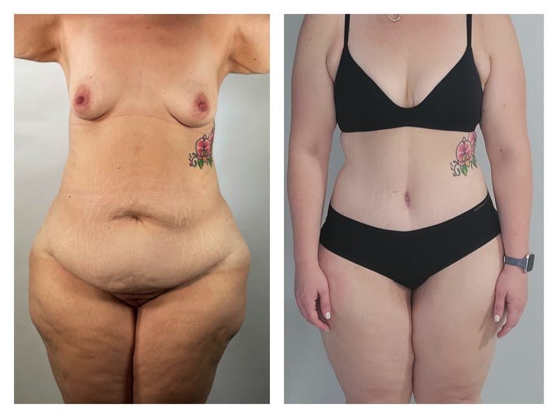 Liposuction Before & After Gallery - Patient 133183636 - Image 1