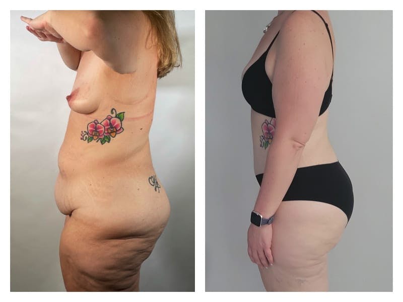 Brazilian Butt Lift Before & After Gallery - Patient 133183635 - Image 3