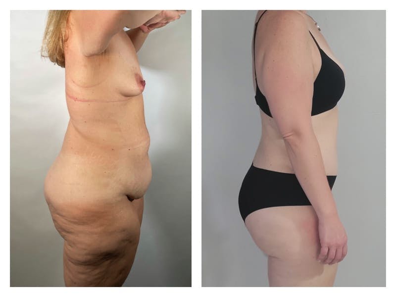 Brazilian Butt Lift Before & After Gallery - Patient 133183635 - Image 4