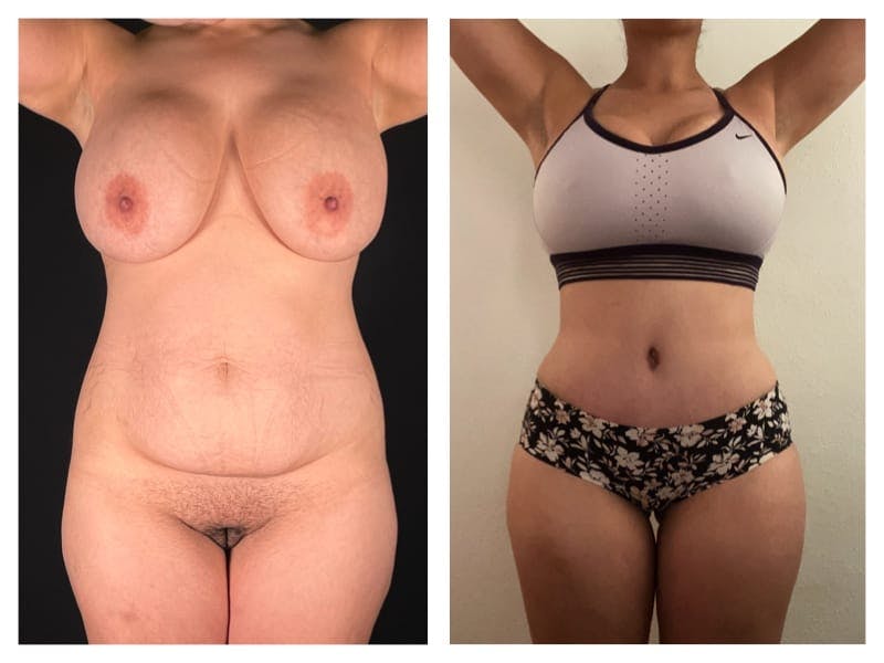 Tummy Tuck Before & After Gallery - Patient 133183638 - Image 1