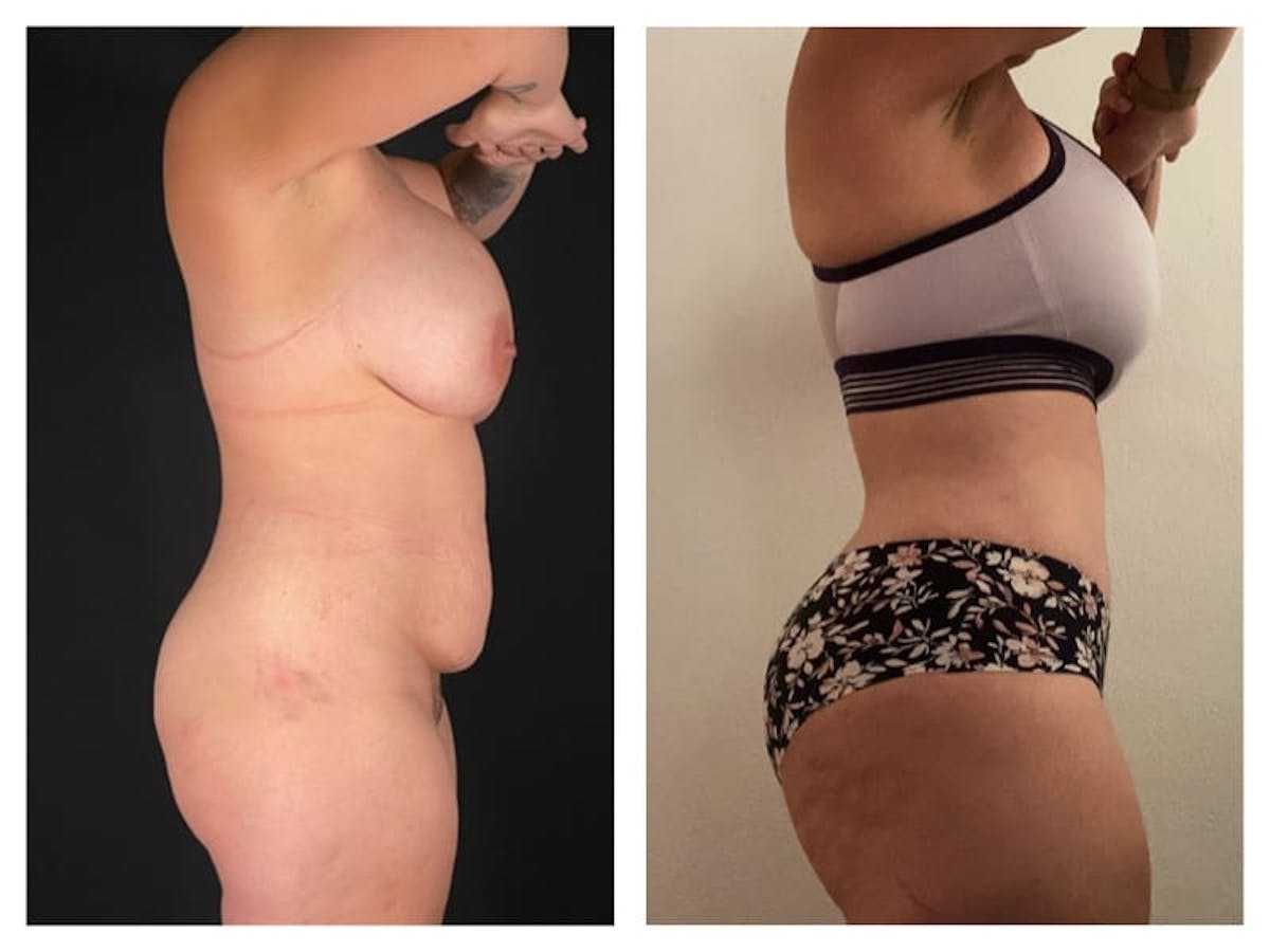 Tummy Tuck Before & After Gallery - Patient 133183638 - Image 4