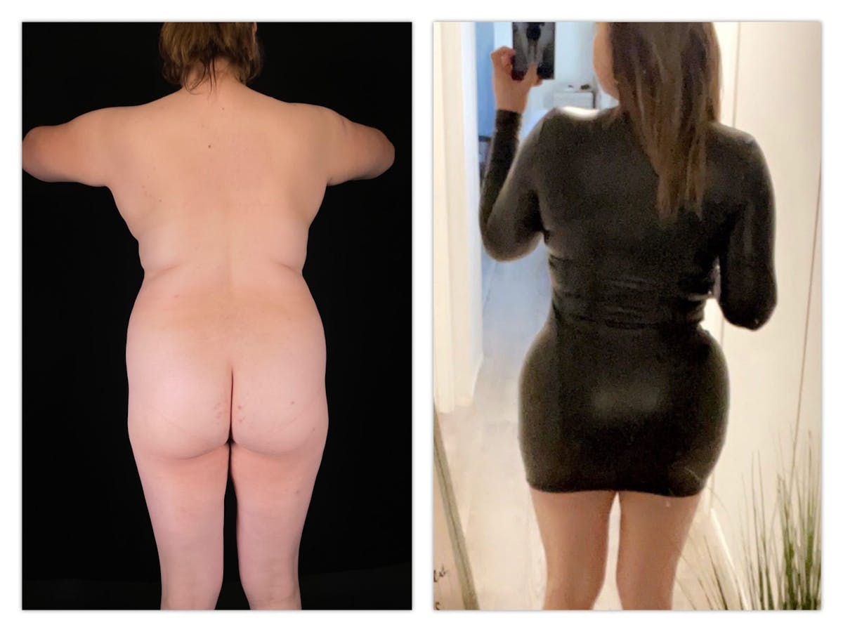 Brazilian Butt Lift Before & After Gallery - Patient 133183663 - Image 1