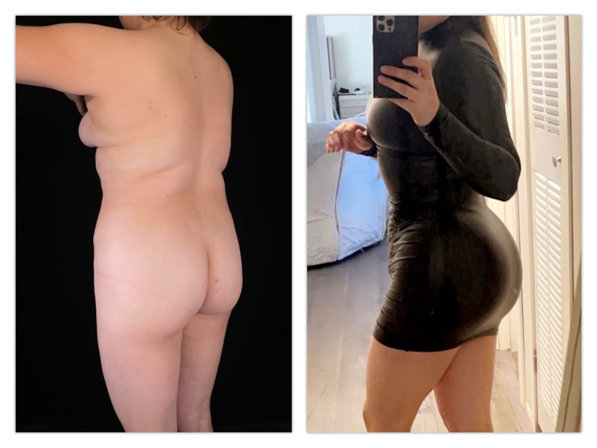 Brazilian Butt Lift Before & After Gallery - Patient 133183663 - Image 2