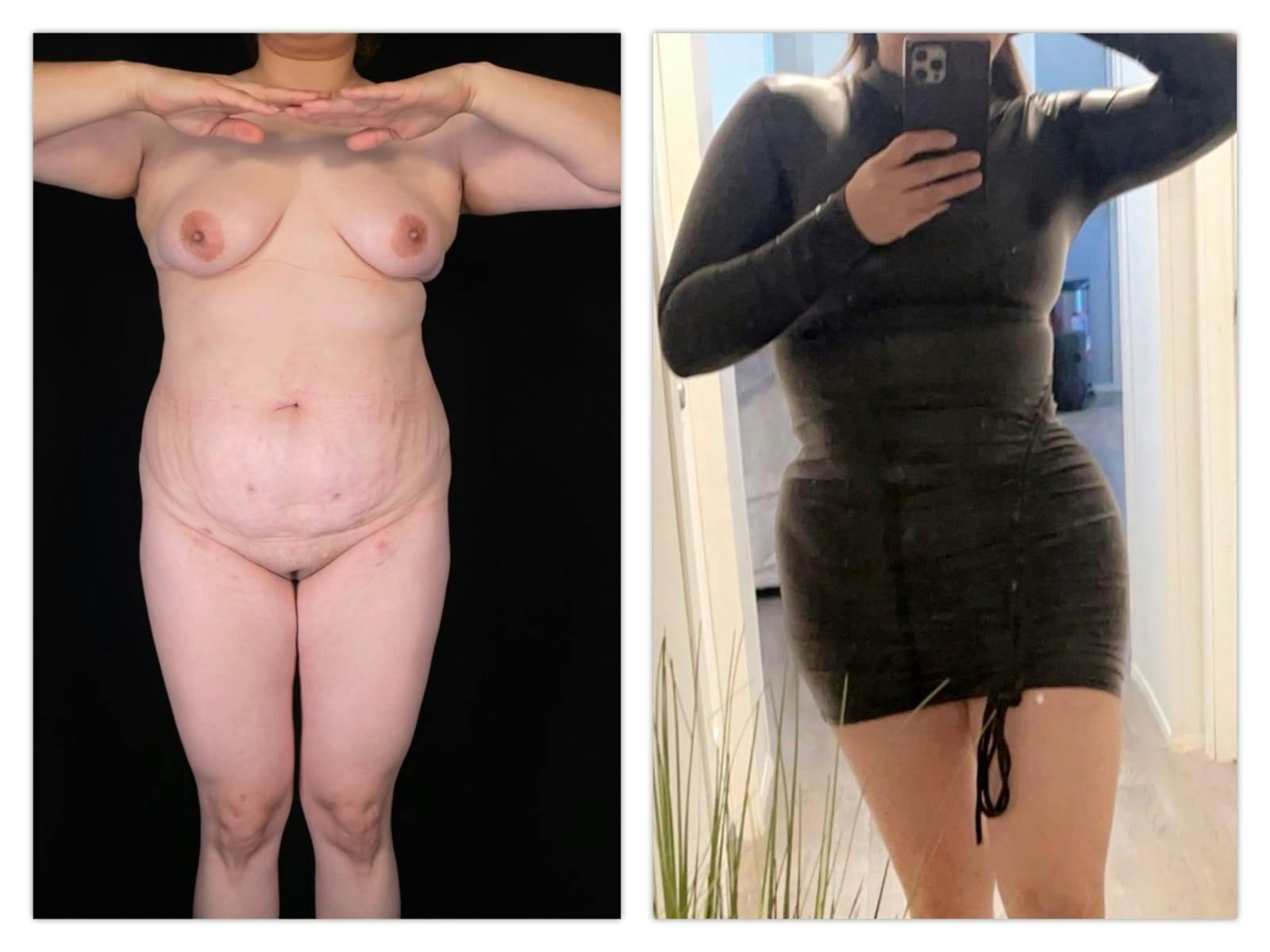 Brazilian Butt Lift Before & After Gallery - Patient 133183663 - Image 3