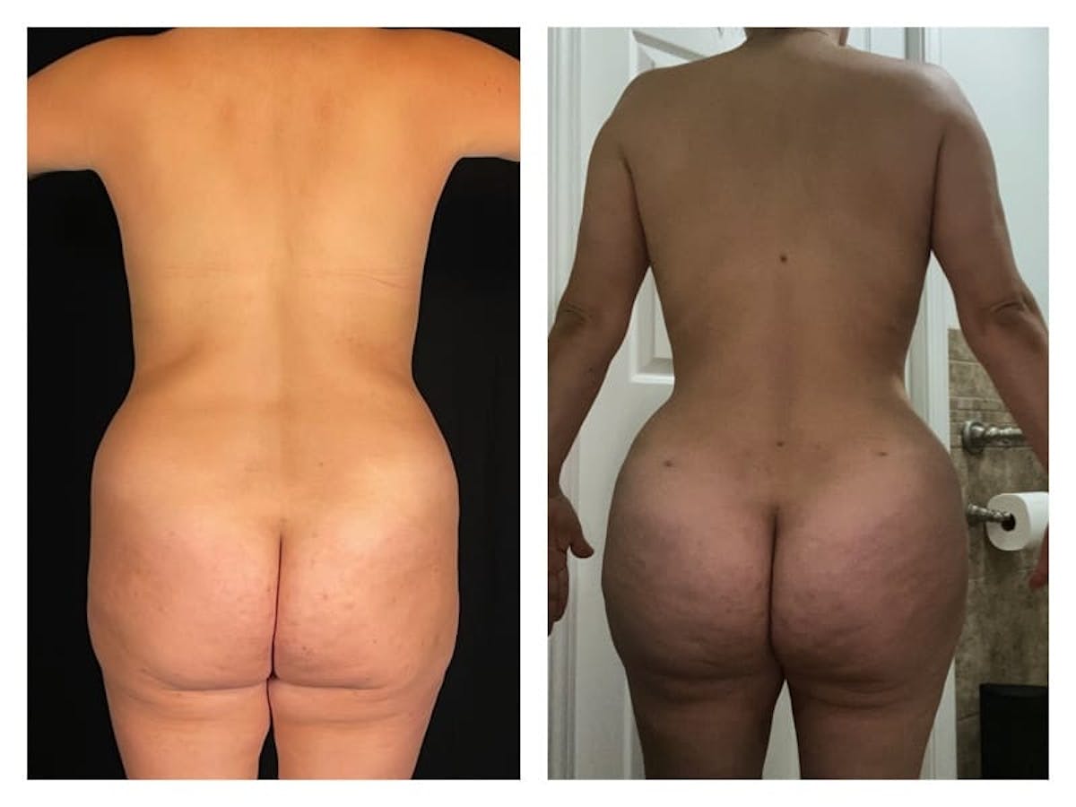 Tummy Tuck Before & After Gallery - Patient 133183664 - Image 2