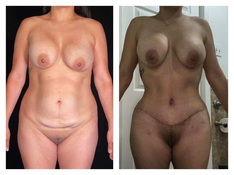 Tummy Tuck Before & After Gallery - Patient 133183664 - Image 1