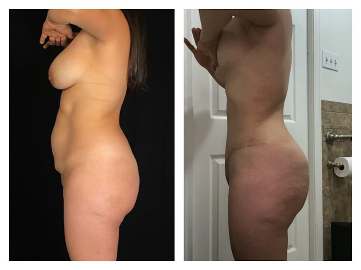 Brazilian Butt Lift Before & After Gallery - Patient 133183666 - Image 2