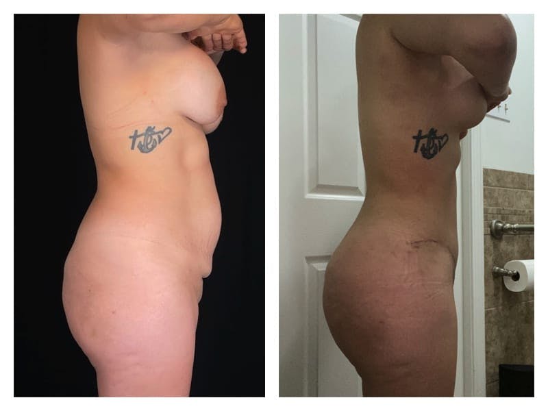 Brazilian Butt Lift Before & After Gallery - Patient 133183666 - Image 4