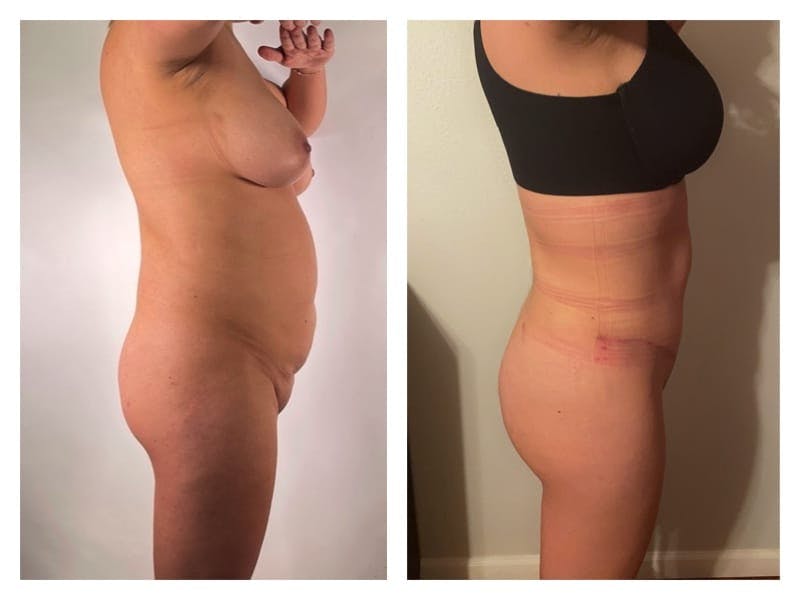 Mommy Makeover Before & After Gallery - Patient 133183667 - Image 3