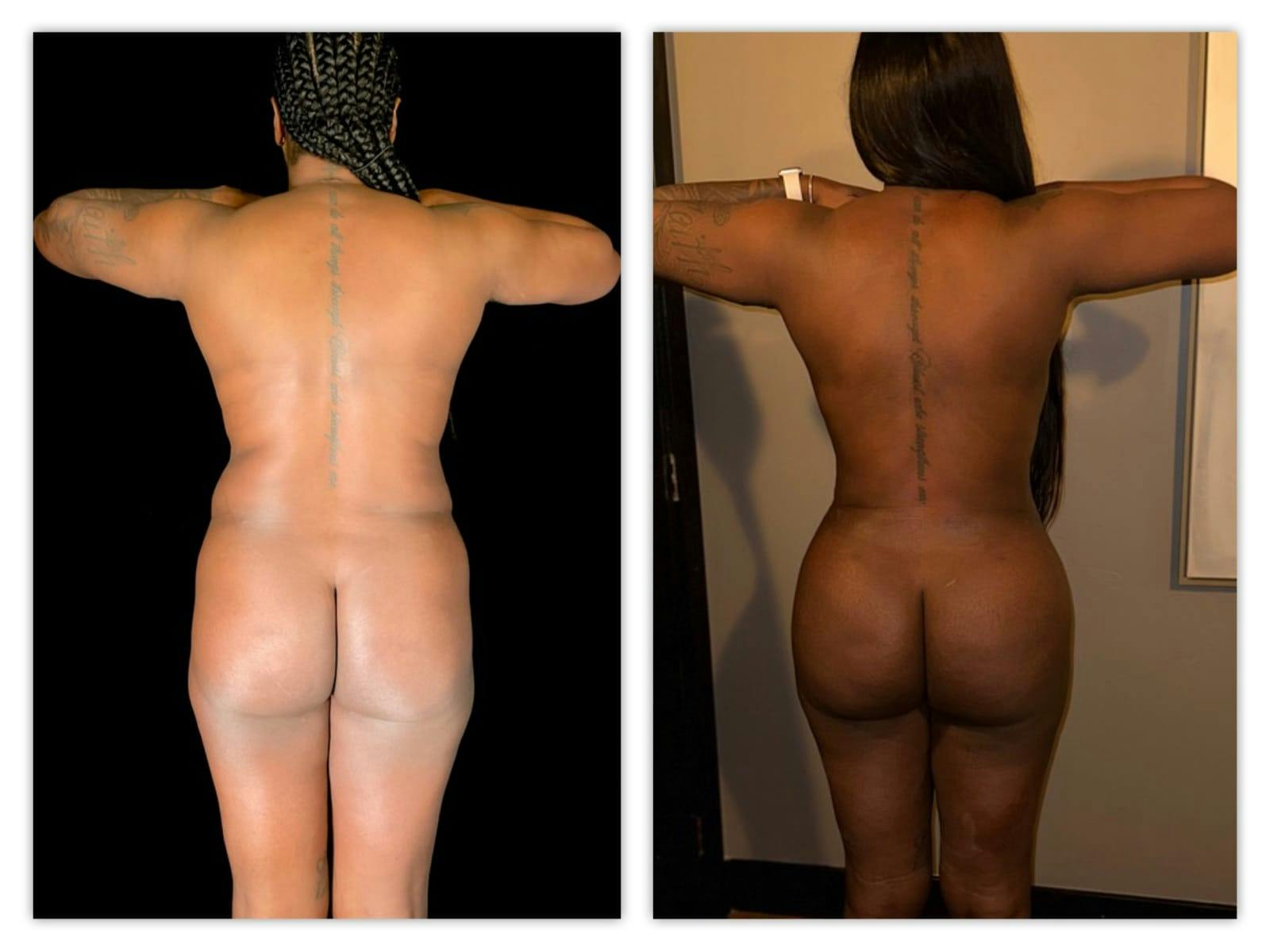Brazilian Butt Lift Before & After Gallery - Patient 133183669 - Image 1