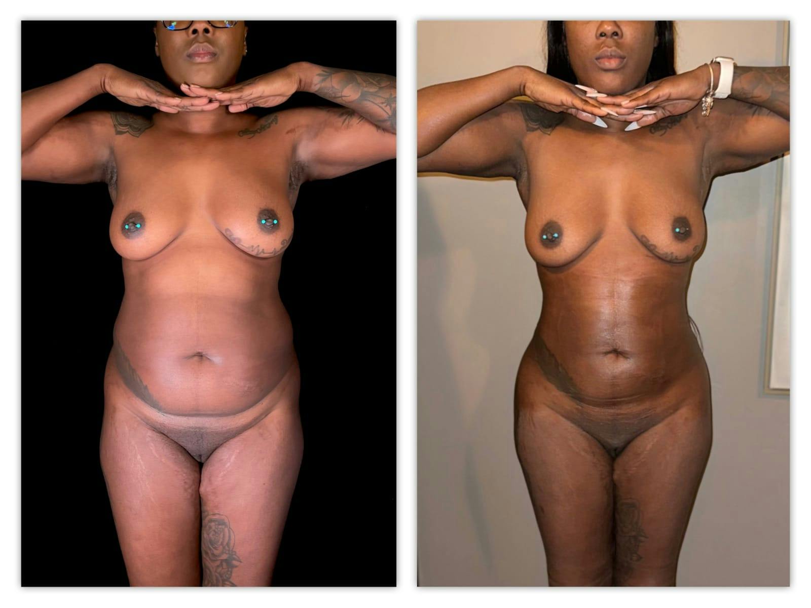 Brazilian Butt Lift Before & After Gallery - Patient 133183669 - Image 4