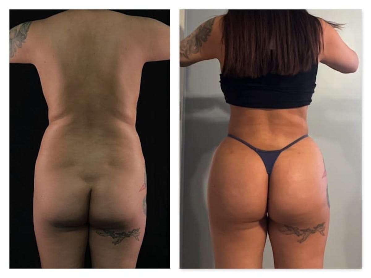 Brazilian Butt Lift Before & After Gallery - Patient 133183815 - Image 1