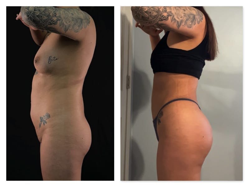 Brazilian Butt Lift Before & After Gallery - Patient 133183815 - Image 3