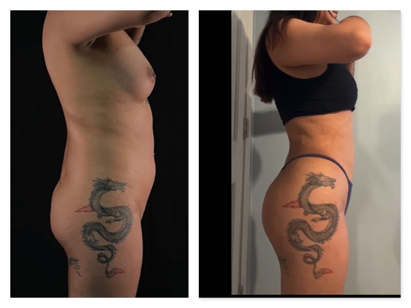 Brazilian Butt Lift Before & After Gallery - Patient 133183815 - Image 4