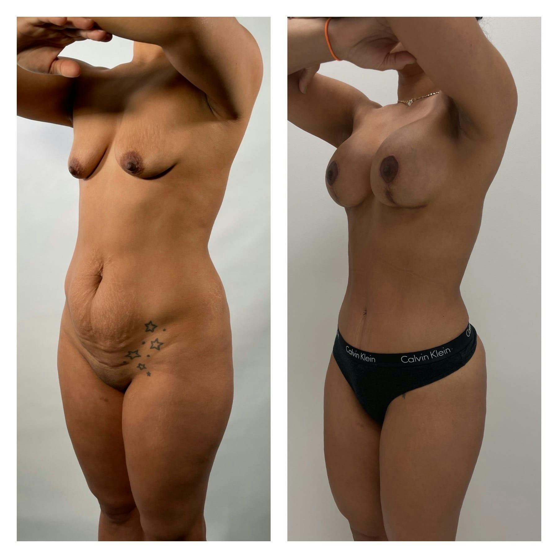Mommy Makeover Before & After Gallery - Patient 133183823 - Image 2