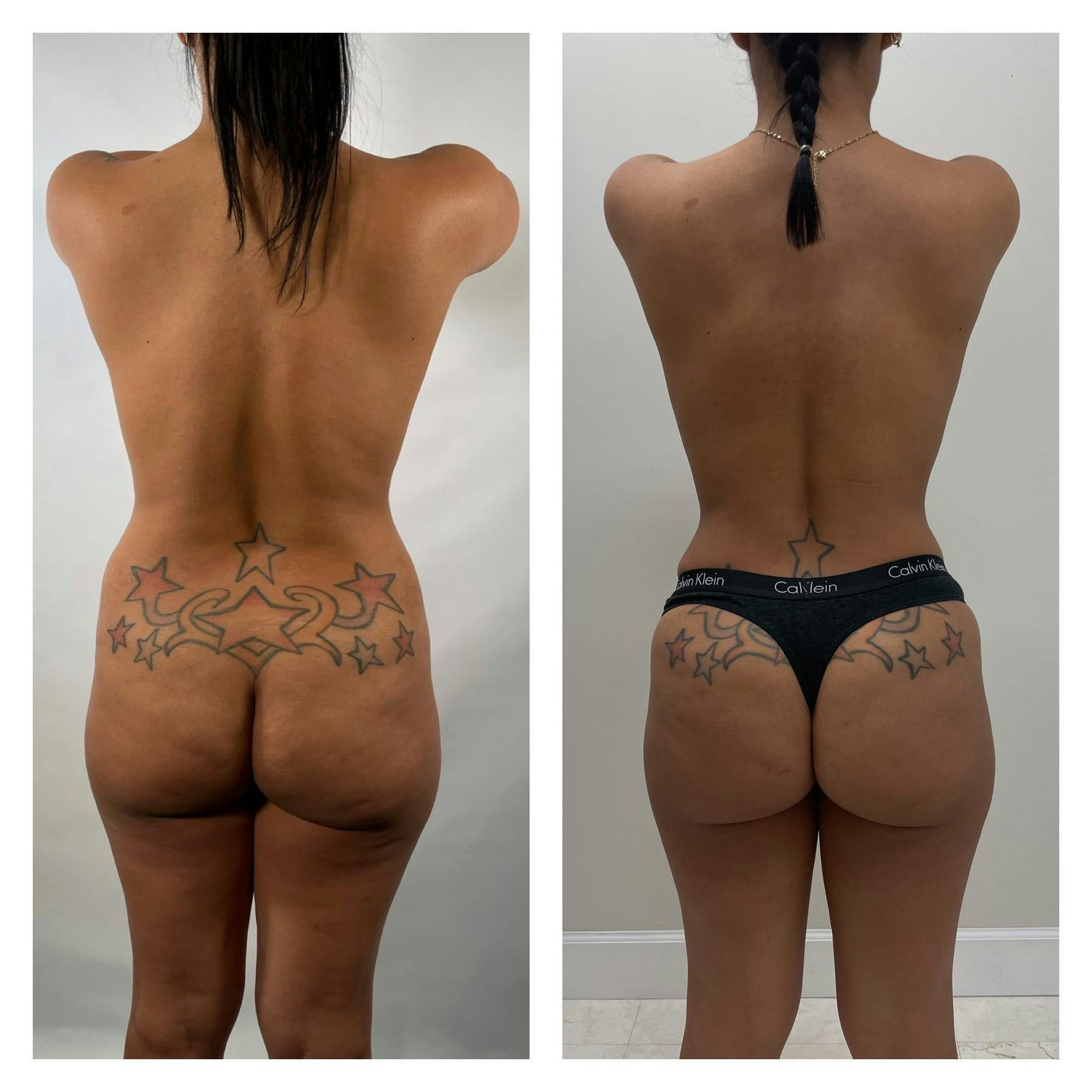 Mommy Makeover Before & After Gallery - Patient 133183823 - Image 4