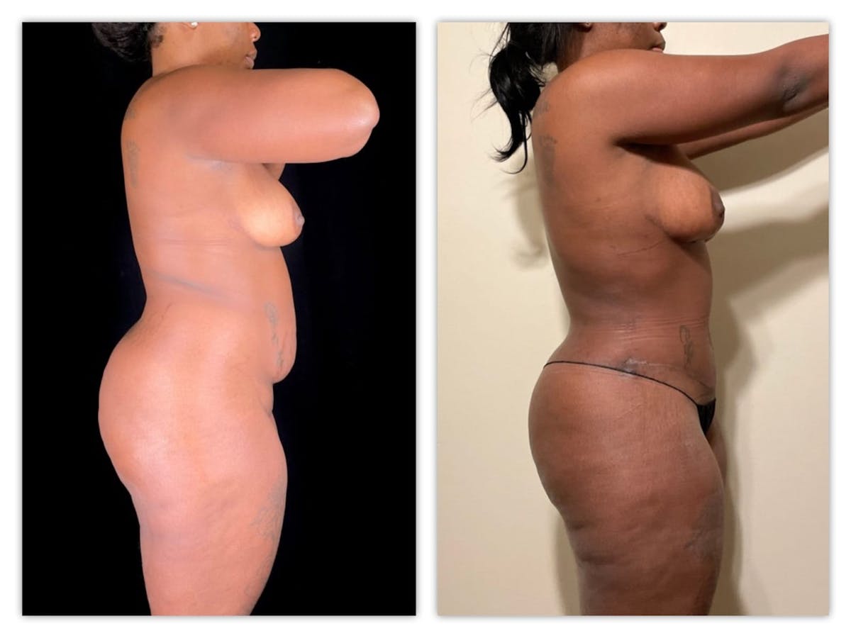 Tummy Tuck Before & After Gallery - Patient 133183825 - Image 3